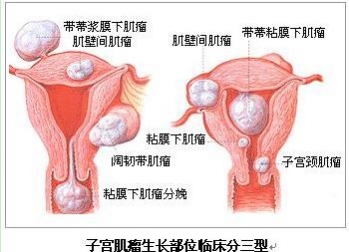 子宫肌瘤怎么治疗 手术后是否会复发